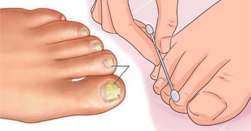 Banish fungal nails with this effortless homemade remedy!